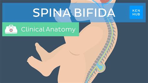 bufuda|Spina Bifida: Types, Tests, Treatment & Prevention